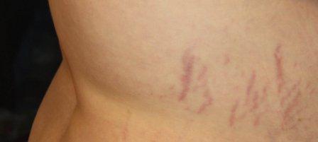 Stretch marks