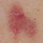 Melanoma Skin Cancer