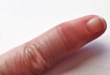 What is psoriatic arthritis treatment