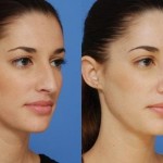 The Realistic Facts About Nose Surgery