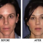 Revive Skin Care Side Effects