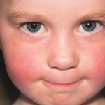 Skin Disorders in Children Symptoms