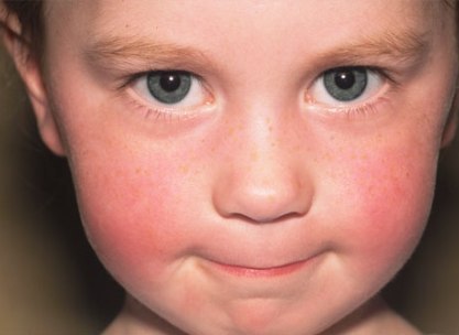 Skin Disorders in Children Symptoms