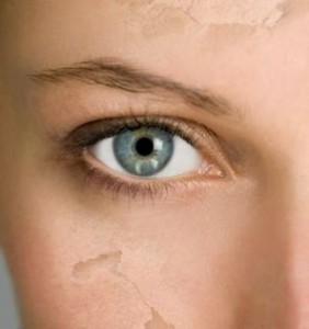 dry facial skin