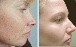 photorejuvenation-procedure