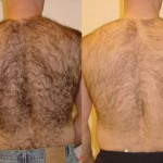 The Pain Chart for Back Hair Removal