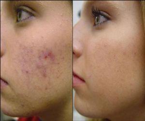 Dark-Spots-on-Face-Treatment