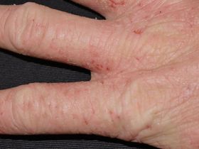Different-Types-of-Eczema-Skin-Conditions