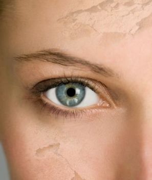 Extremely-dry-skin
