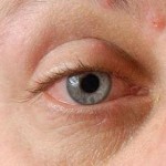 How Do You Get Shingles in the Eye?
