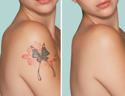 Laser Tattoo Removal