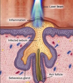 Laser-Treatment-for-Acne