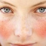 Natural Remedy for Rosacea Treatment