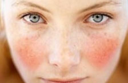 Natural-Remedy-for-Rosacea-Treatment