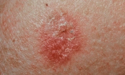 Skin Cancer