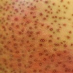 What’s Causing Those Skin Marks?