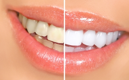 Teeth-Bleaching