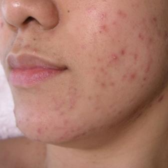 acne-breakouts