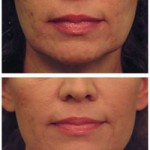 Basic Skin Tightening Procedures