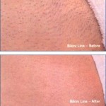 Bikini Wax – Truth About the Painful Adventure