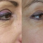 The Evolution of the Fractionated Laser