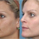 3 Different Types Of Skin Rejuvenation