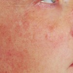 sun-damaged-skin-treatment