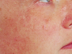 sun-damaged-skin-treatment