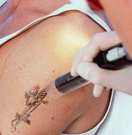 tattoo-removal