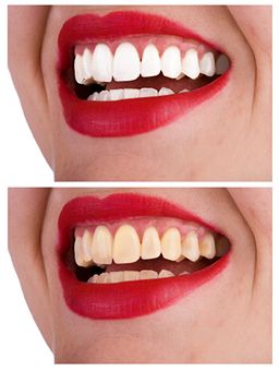 teeth-whitening-products