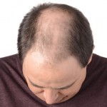 early signs of male pattern balding