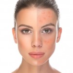 cover your Rosacea with makeup tips
