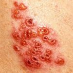 Having shingles vaccination – good or bad for you?