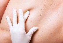 5 Natural Ways to Get Rid of Skin Moles
